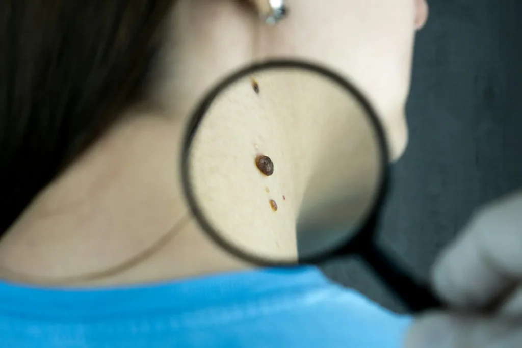 Procedimientos Dermatológicos - Dermapell